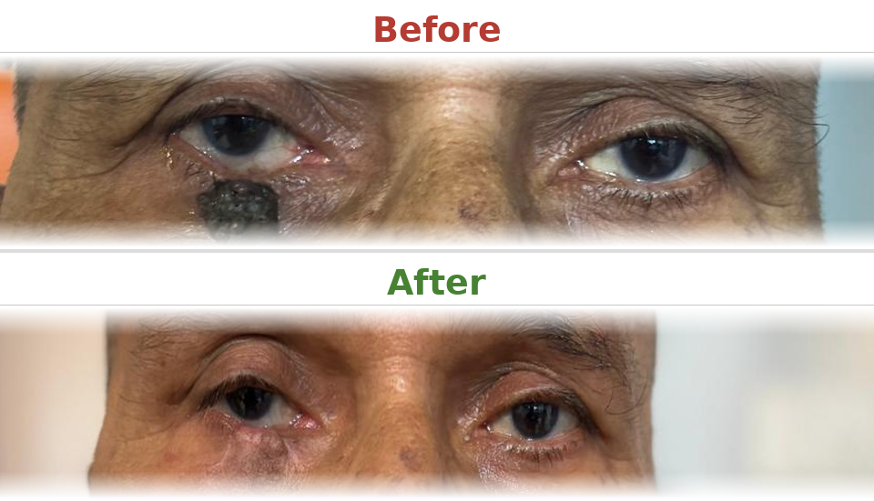 Ectropion correction - Before and After