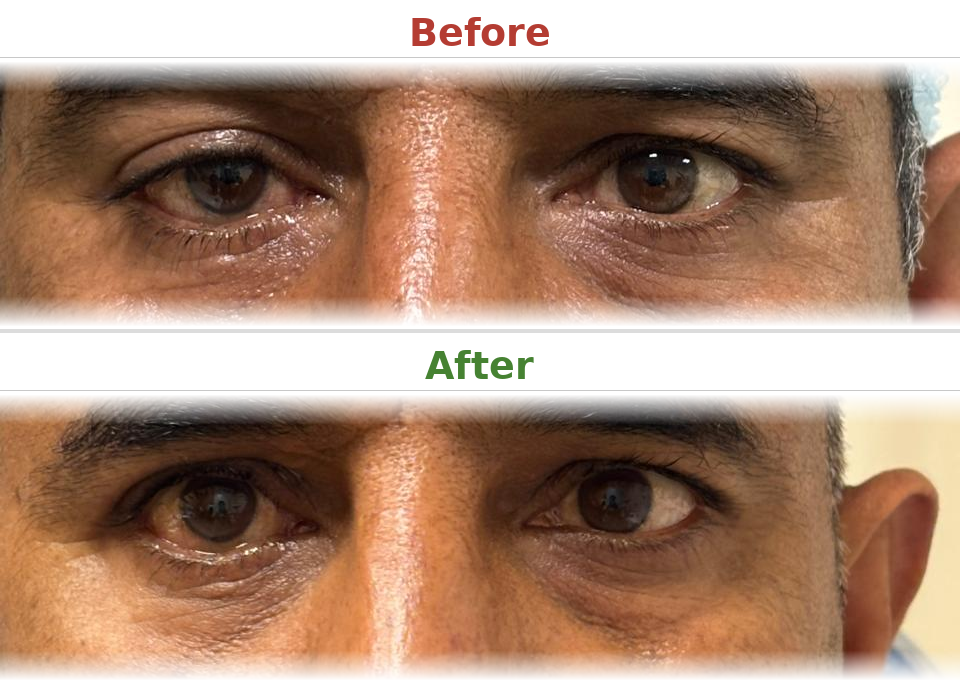 Blepharoplasty - Before and After